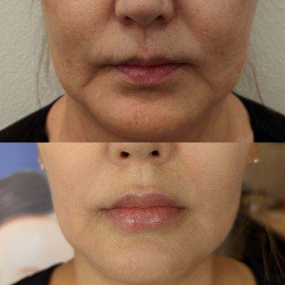 1. 2nd Lip Filler Touch Up
2. Skintox Injection