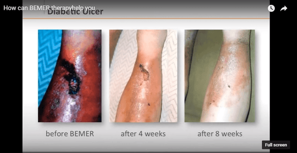 Diabetic Ulcers clearing up in 8 weeks. Bemer greatly increases the microcirculation.