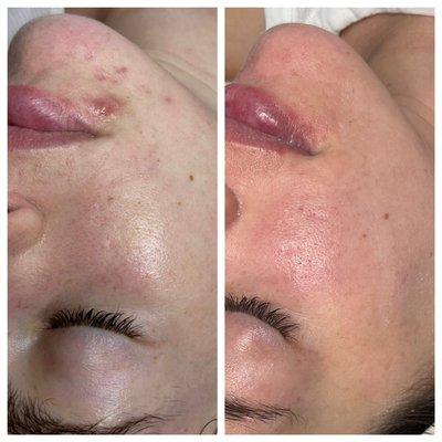 Before & After Acne facial