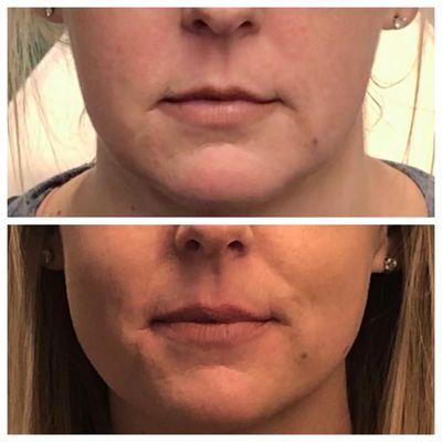 Masseter Facial Slimming before/after Botox