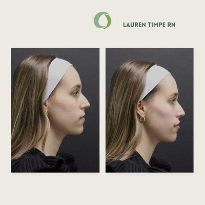 Before + after cheek, chin and lip filler by Nurse Lauren Timpe