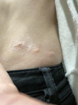 Bug bites