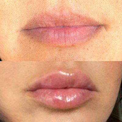 Lips before and after (touch of bruising)