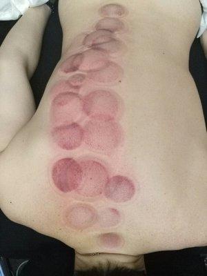 For certain conditions, cupping may be indicated. These are not bruises. Treatments are akin to deep tissue massage.