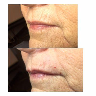 Lip enhancement with filler..