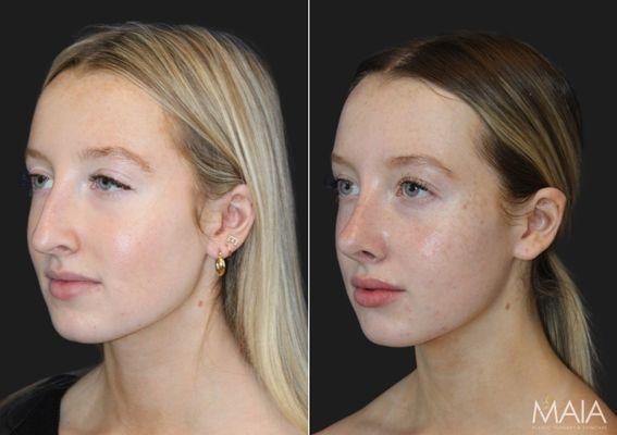 Before and after rhinoplasty: Patient's transformation to boost confidence, with Dr. Maia's expertise in Tysons Corner, VA.