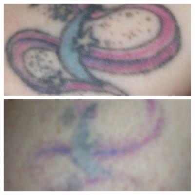 Before and after on tattoo removal...that was 8 sessions in but I have no scarring and it's very faded right now