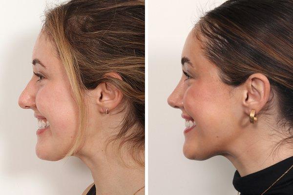 7 months after open rhinoplasty by Dr. Benjamin Paul