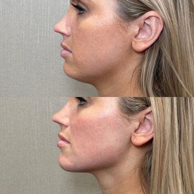 Jawfiller can be a powerful tool in balancing out your profile!