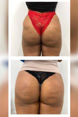 Sculptra Butt Lift - Results after 3 treatments.