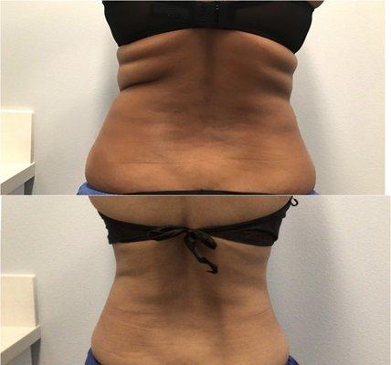 Amazing reduction in bra fat, waist and flanks with CoolSculpting Elite!