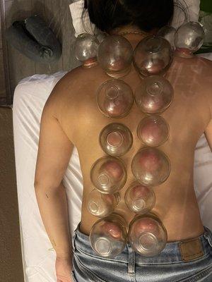 Cupping for muscle tension and Back discomfort