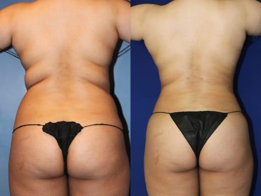 VASER Lipo: Hips & waist