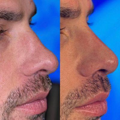 Liquid Rhinoplasty