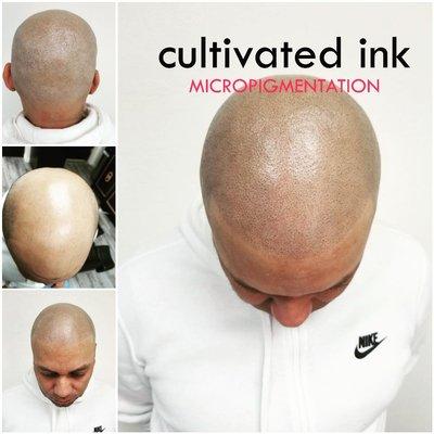 Scalp micropigmentation