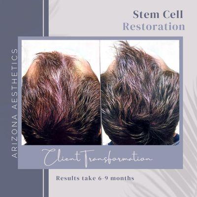 Stem Cell Resoration Before and After