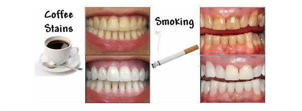 Ask about our in office whitening!