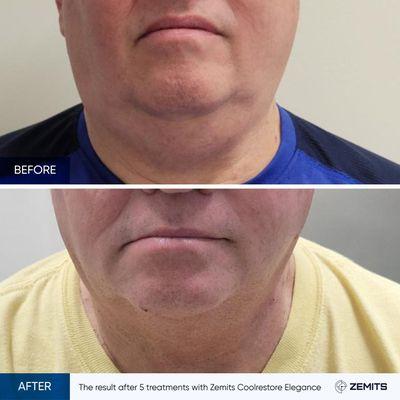 Cryo slim is an excellent treatment for double chins. This is after 3 treatments.