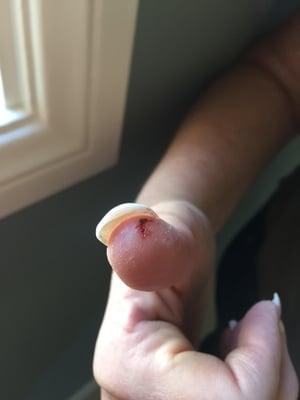 The picture hardly does it justice. The gouge that was taken out of my thumb by the drill. It's only one of 8 other nicks from my fill.