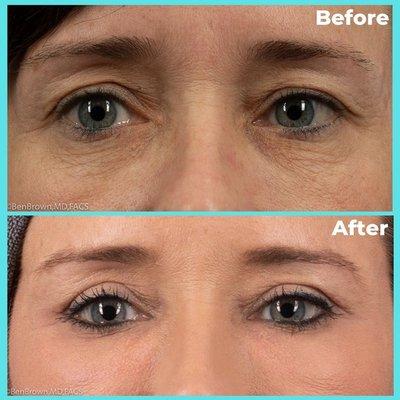 Upper And Lower Blepharoplasty or Eyelid Lift. Fat Grafting to Lower Lid Junction with Erbium Ablative Laser to Lower LIds