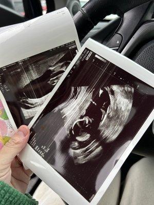 Here are the only ultrasound pictures I got (2).