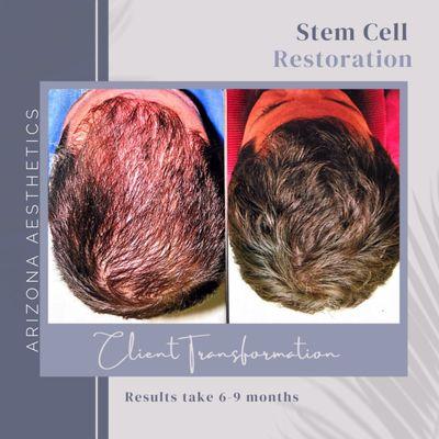 Stem Cell Resoration Before and After