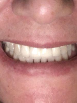 this is my smile thank you  Dr Milner , a photo of his work