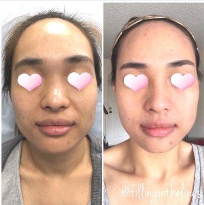 Non-surgical Rhinoplasty with Raddiesse (last up to 2 years)