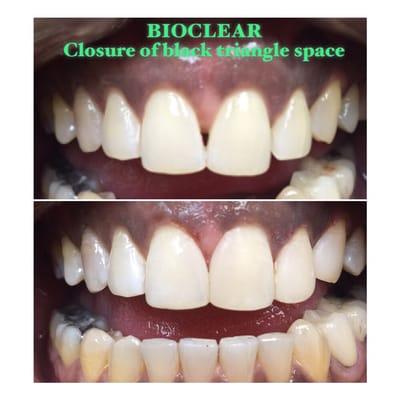 Bioclear bonding- closure of black triangle space after ortho treatment