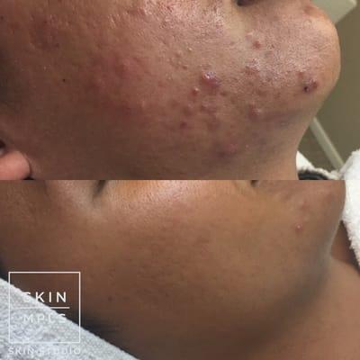 Just 3 treatments and 3 months of a curated acne-clearing skincare regimen was all it took to clear her acne after years of struggling.