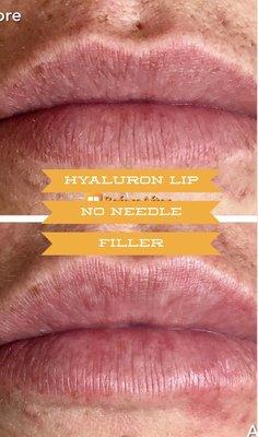 Hyaluron lip infusion