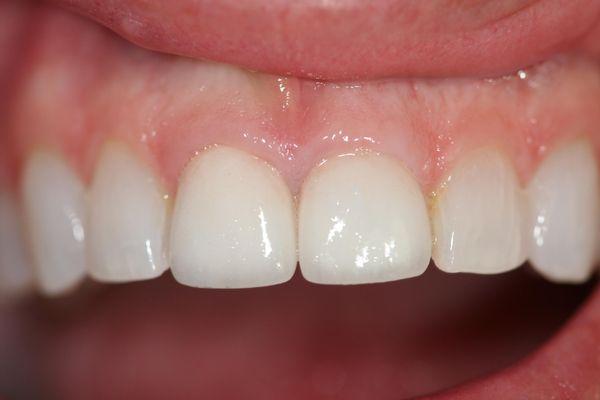 #8.9. Layered Zirconia  Crown