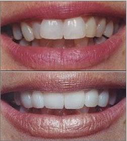 Veneers, before and after shots
