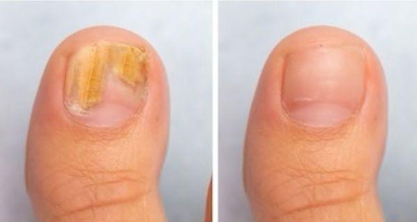 Before and after of fungal nail treatment