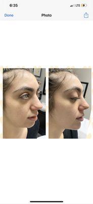 Chin fillers before and after!