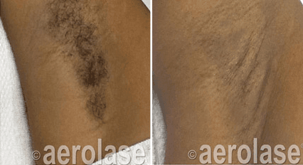 Before and After Laser Hair Removal.