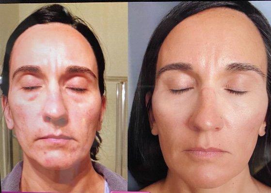 Chemical peel