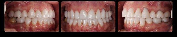 Beautiful, healthy smile completed in a single visit.