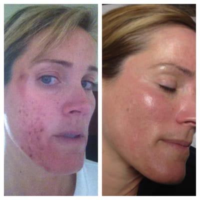 My client came to me with adult acne we worked together through facials peels and lira clinical homecare to achieve healthy skin