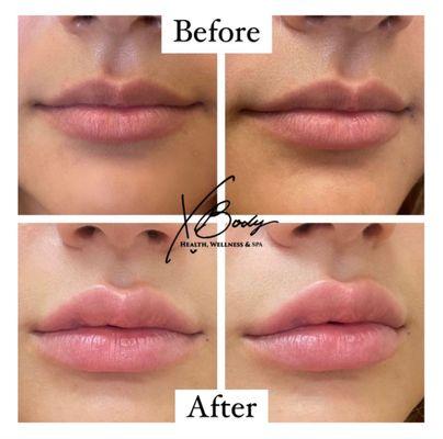 Lip Transformation
1ML of Juvederm