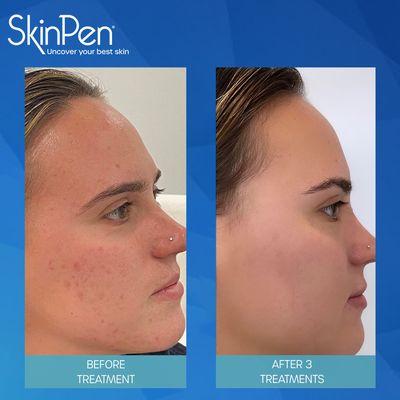 SkinPen Microneedling Treatment