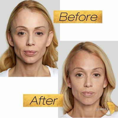 Sculptra treatment before and after results.