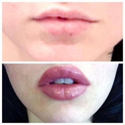 Before and after 1 and a half syringes of restylane. Done by the amazing Shahla!