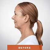 Before Kybella Injection