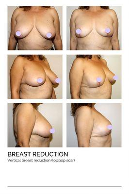 Breast Reduction