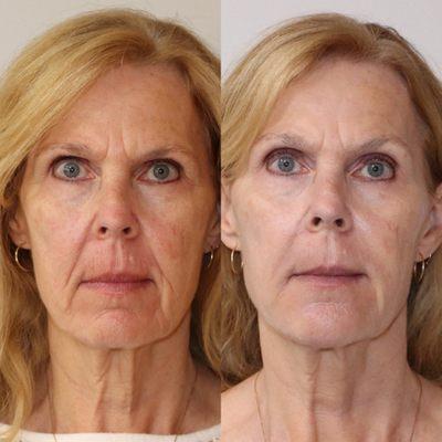 Non-surgical Liquid Facelift using dermal fillers