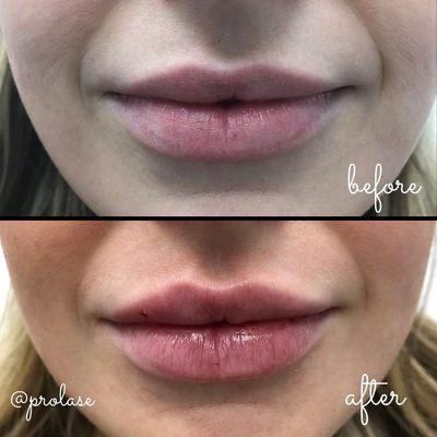 Fuller lips with Juvederm