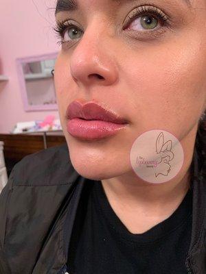 Lip Fillers by @thelipbunny