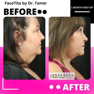 FaceTite, scarless facelift