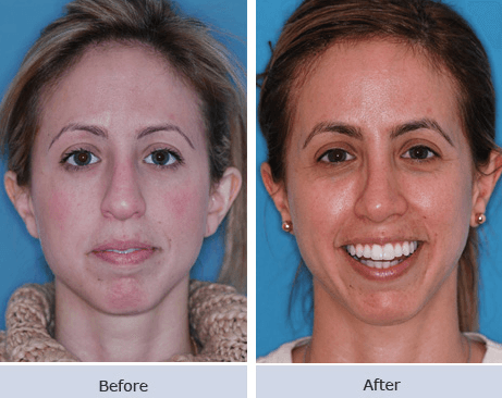 Otoplasty Surgery Before & After